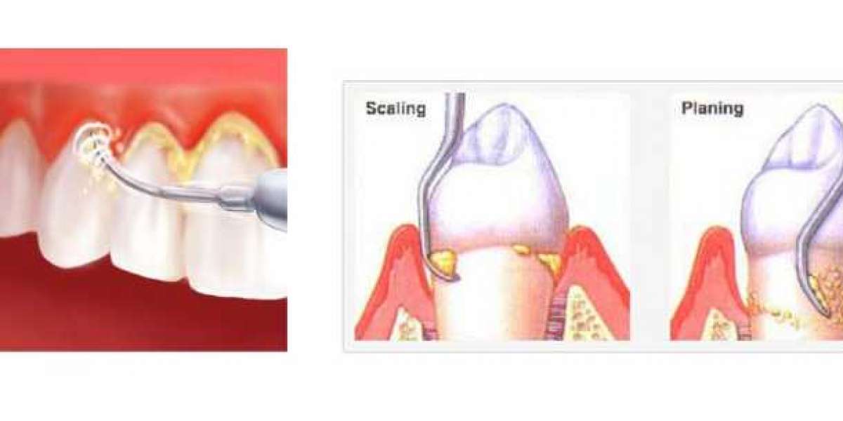 Dental Scaling and Root Planing