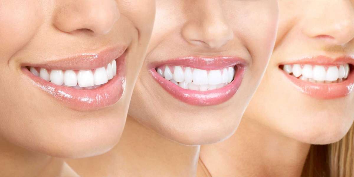 Why Getting Teeth Whitening At Home Is A Smart Move?