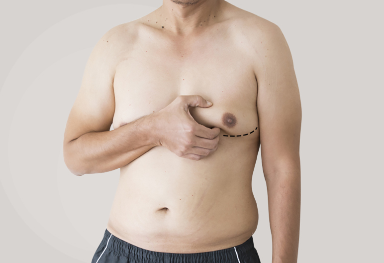 How to Examine Gynecomastia Condition?