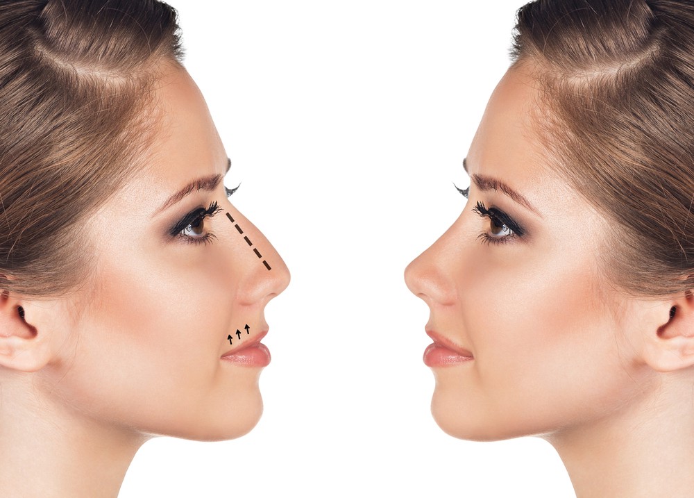 Rhinoplasty: Know All About Procedures & its Benefits