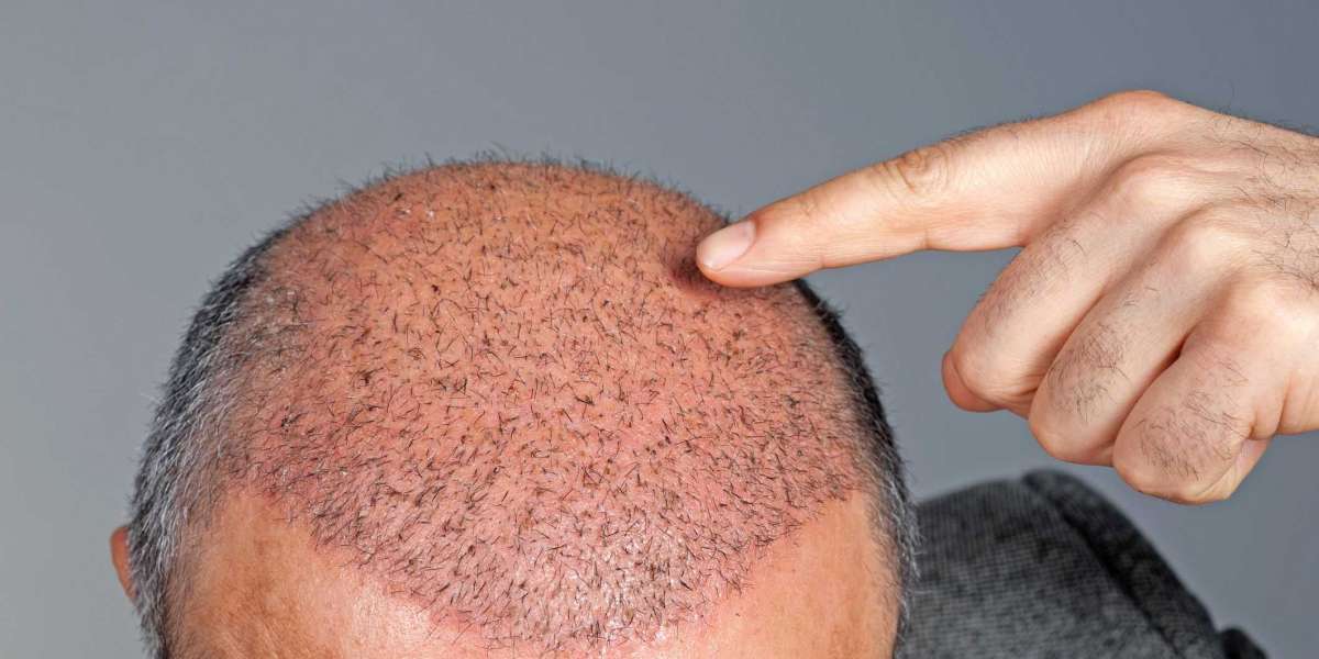 FEMALE HAIR TRANSPLANT: ISN'T IT TIME YOU LEARNED THE TRUTH? Hair transplant cost in Turkey