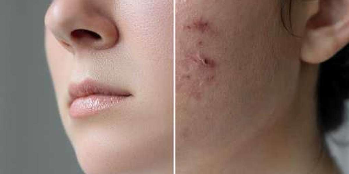 Prevent Future Acne Breakouts With Simple Tips