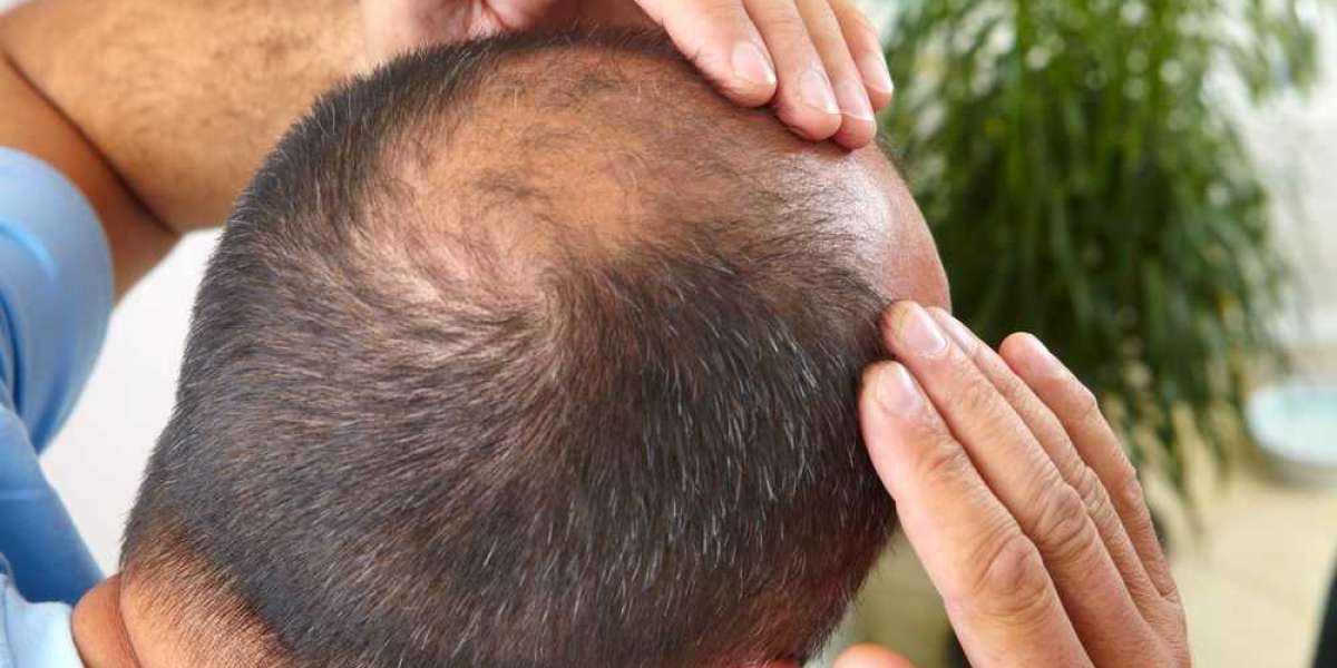 Hair Transplants Baton Rouge | MetaGlow