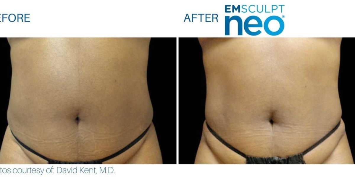 Women's Emsculpt Before and After Stomach