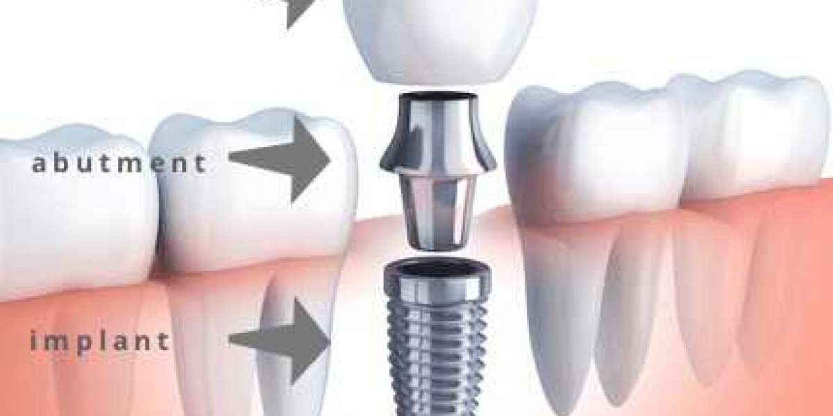 Replace Missing Teeth by Getting Dental Implants