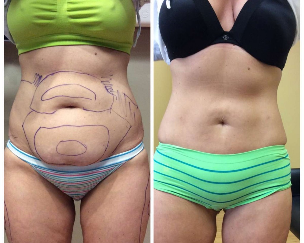 Complete Guide to Liposuction Surgery in Delhi » Dailygram ... The Business Network