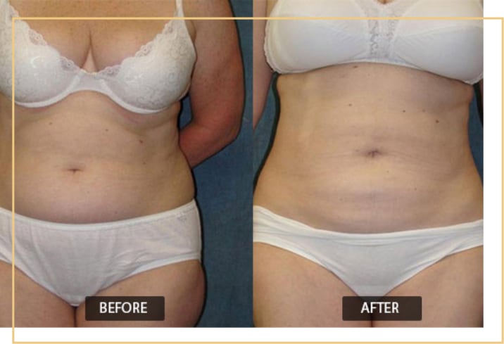 Complete Guide to Liposuction: FAQs to Help You | Journal