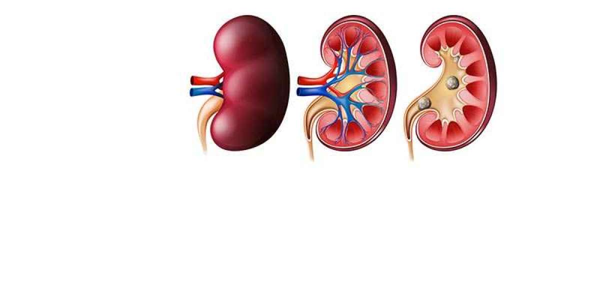 Dr. Niren Rao: Kidney Stone Treatment In Delhi