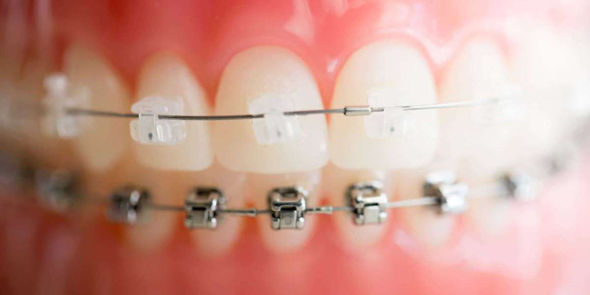 The Benefits of Orthodontic Treatment in Bali: Affordable, High-Quality Care for a Beautiful Smile