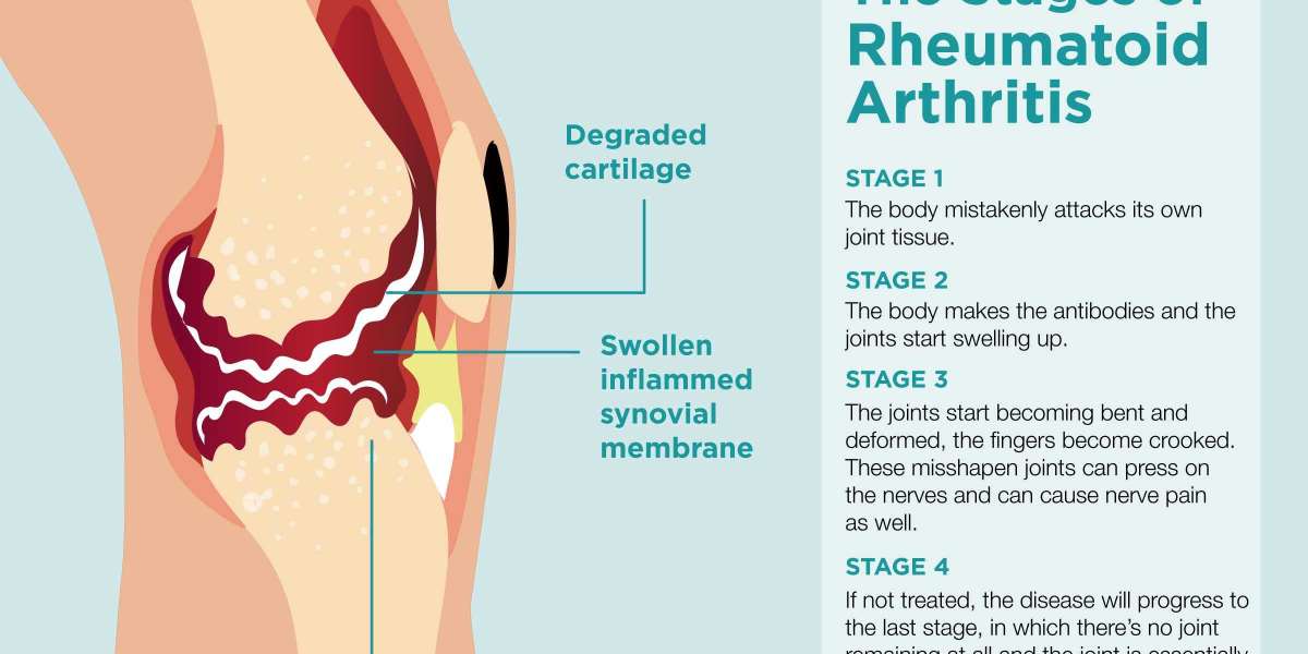 Rheumatoid Arthritis Symptoms