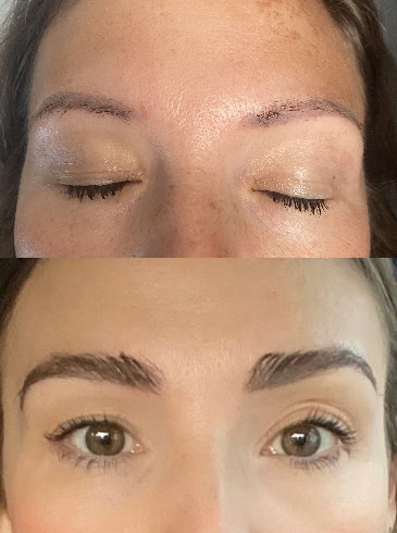 Eyebrow Transplant Services in UK | Surgery Group