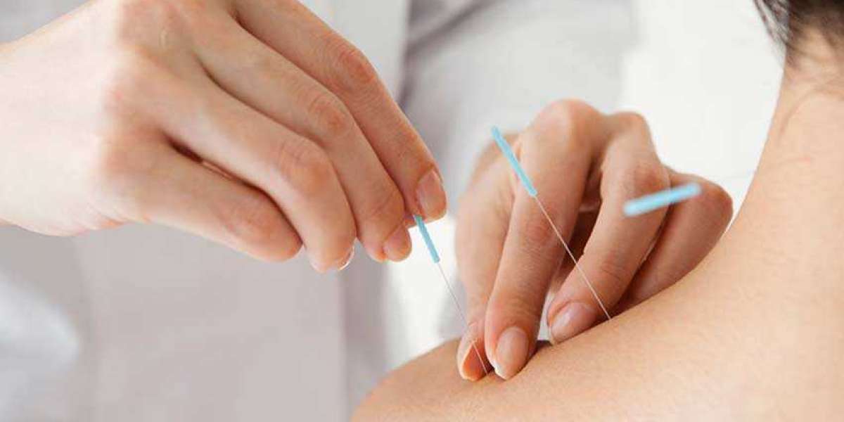 Can Acupuncture Help Sleep Disorders?