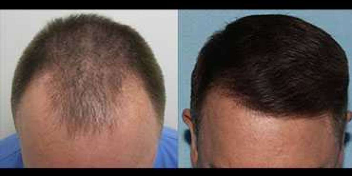 Hair Restoration Service Palm Springs