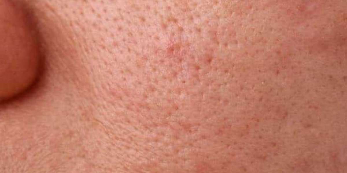 How can I get rid of my open pores on my face?