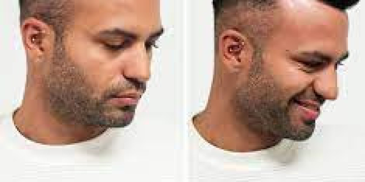 Hair Transplant - The Stages of the Hair Transplant Process