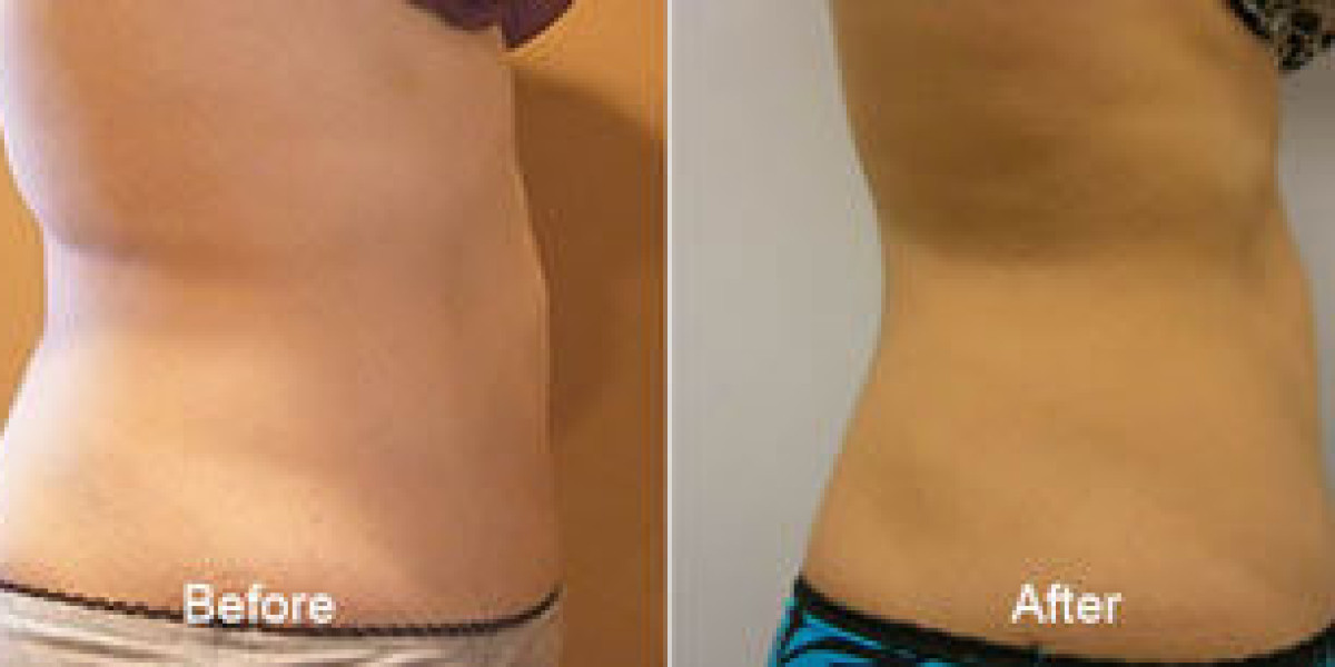 Precision Body Contouring With Body Sculpting Near Me Assisted Liposuction - Details To Know For An Informed Choice