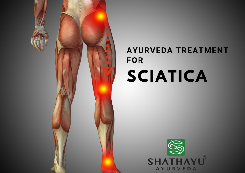 Ayurvedic management of Sciatica | Effective Ayurvedic Treatment for Lower Back Pain and Sciatica