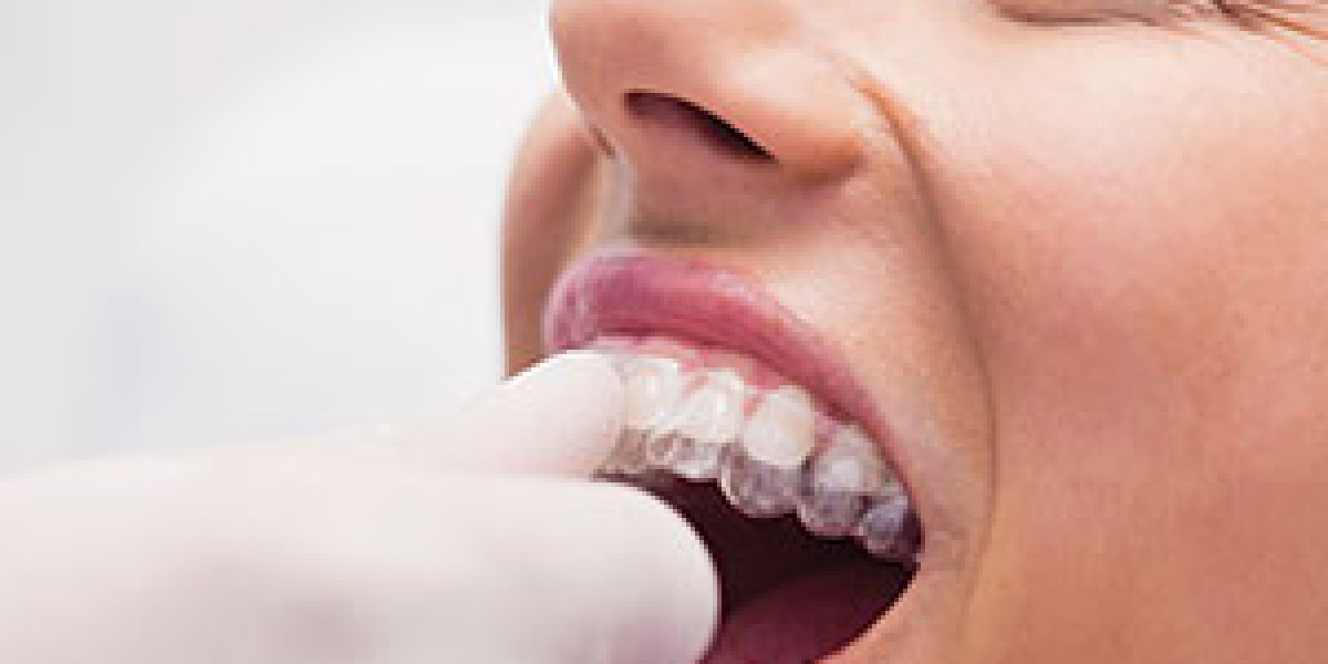 Dental Implant Delhi - Best Dentist in New Delhi