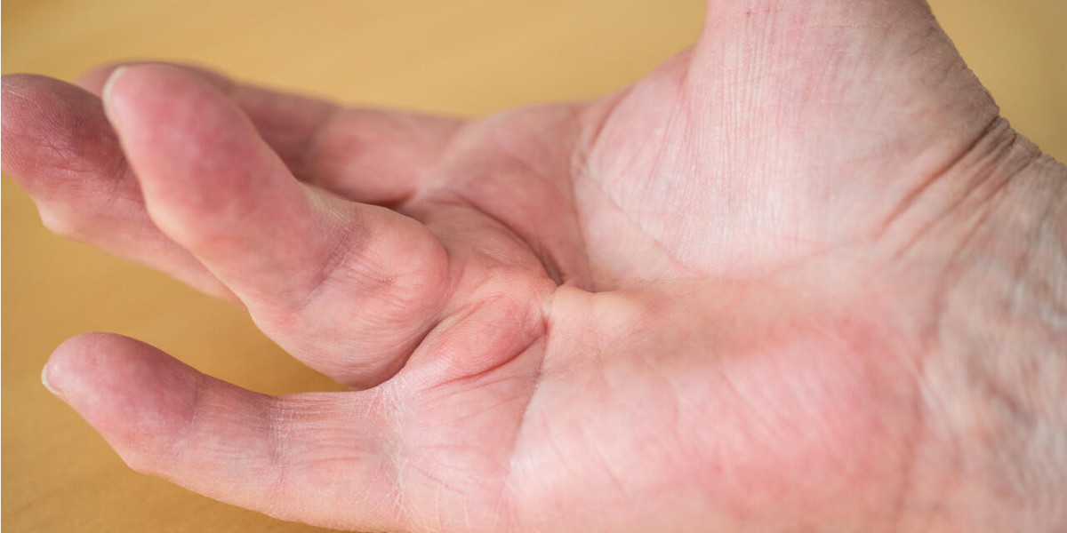 Research report on Global Dupuytren’s Contracture Market Share with Industry Size & Future Growth