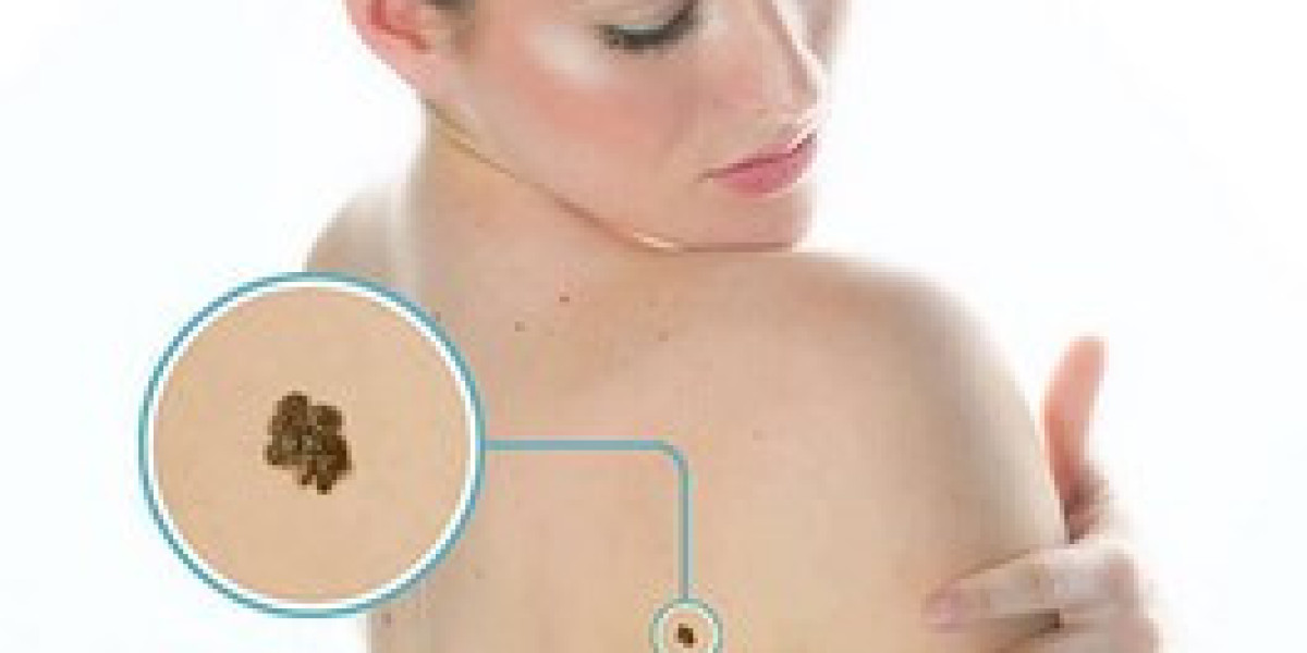 Dermisolve Skin Tag Remover Serum WhereToBuy