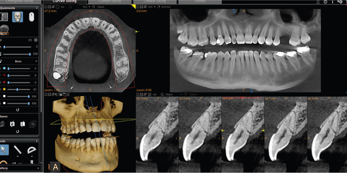 Global CBCT Dental Imaging Market Share & Upcoming Industry Growth | Report Covers Industry Insights on Regional Com