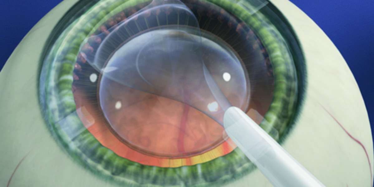 The Global Intraocular Lens Market Share to Witness Many Developments during 2023 -2030; MRFR