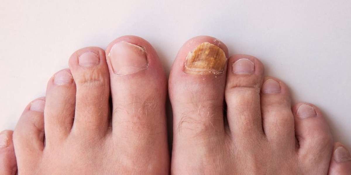 Skinbiotix MD Nail Fungus Reviews – How Does It Remove Toenail Fungus?