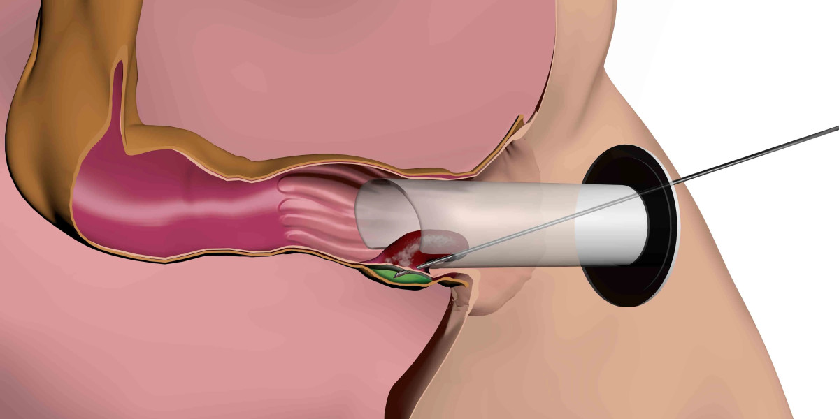 Advanced Innovations Drives the Hemorrhoid Treatment Devices Market Share; MRFR Confirms