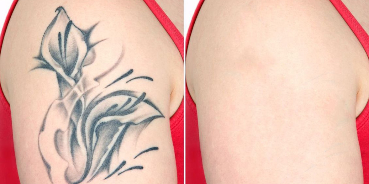 Changing Reimbursement Policies Bound to Push the Tattoo Removal Market Share