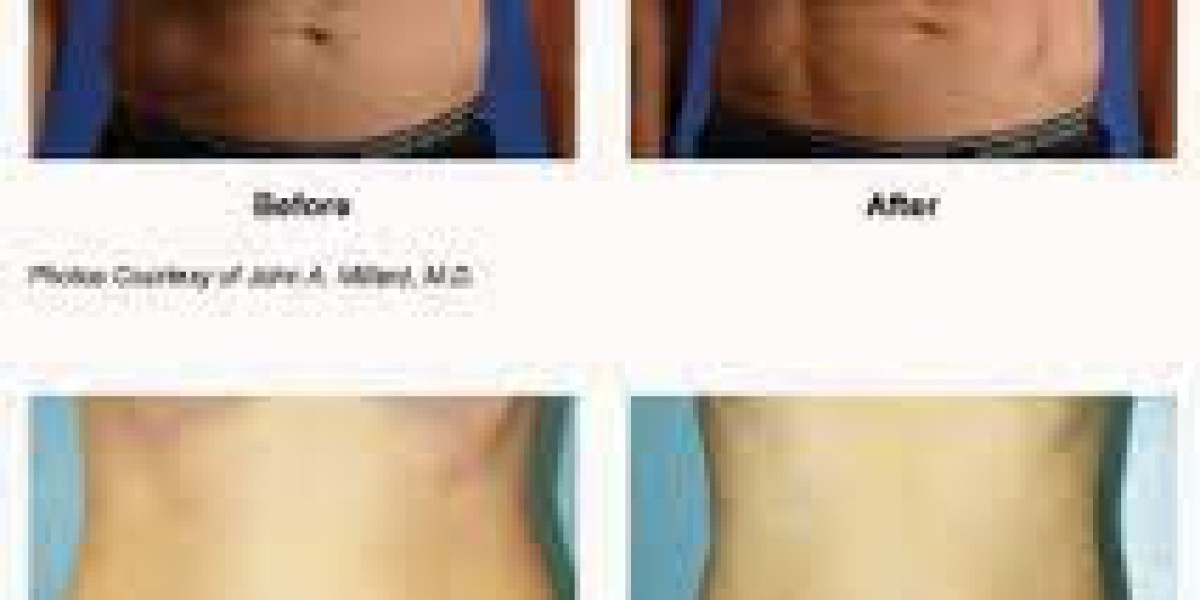 Accusculpt - A Revolutionary and Effective Laser Lipo in Las VegasTreatment