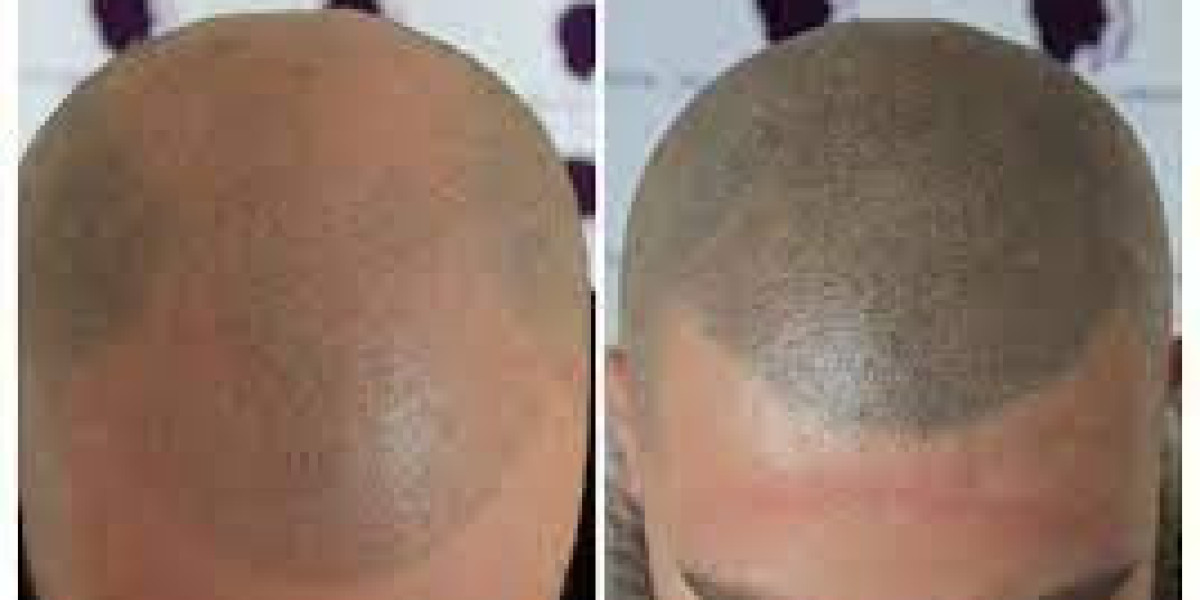 SMP: A Promising Approach for Androgenetic Alopecia