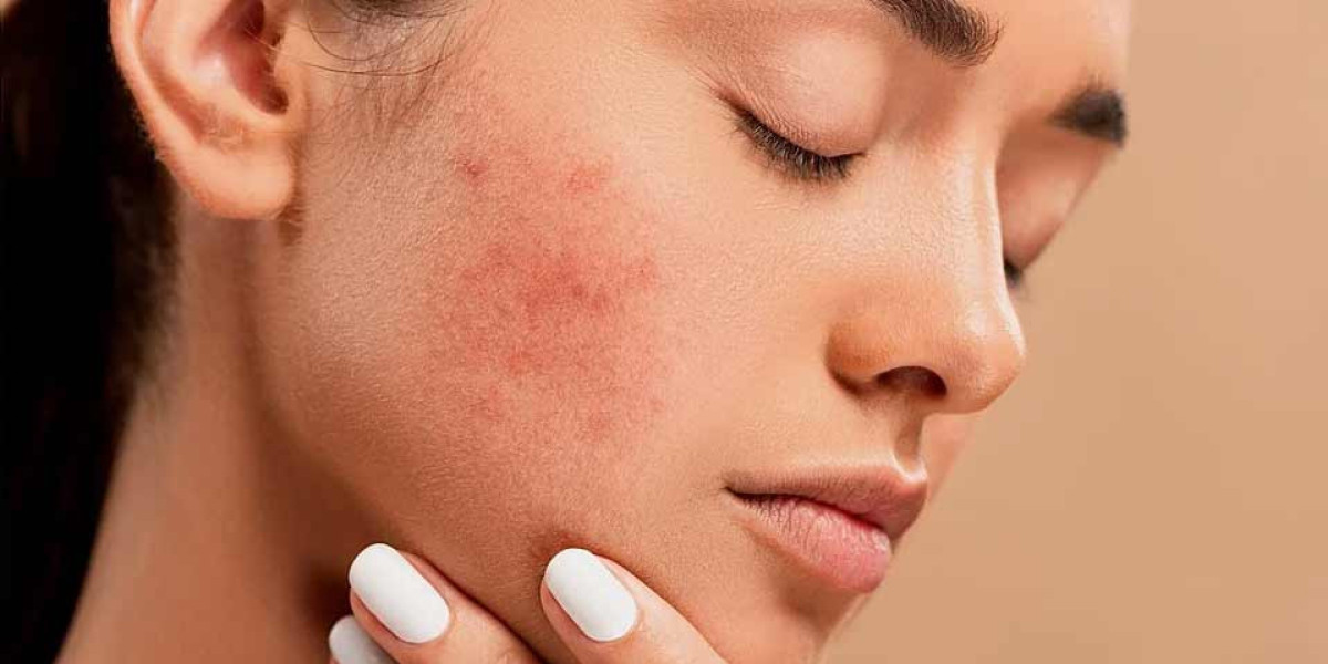Navigating Clear Skin: Your Essential Guide to Acne Treatment in Singapore