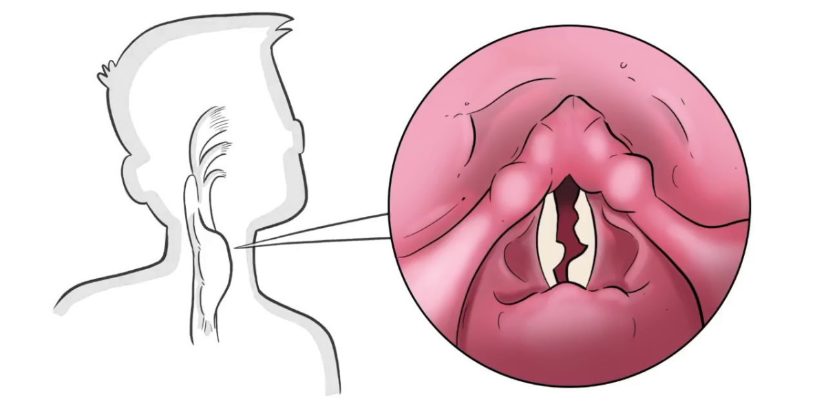 Future Growth Opportunities in the Vocal Cord Paralysis Treatment Market