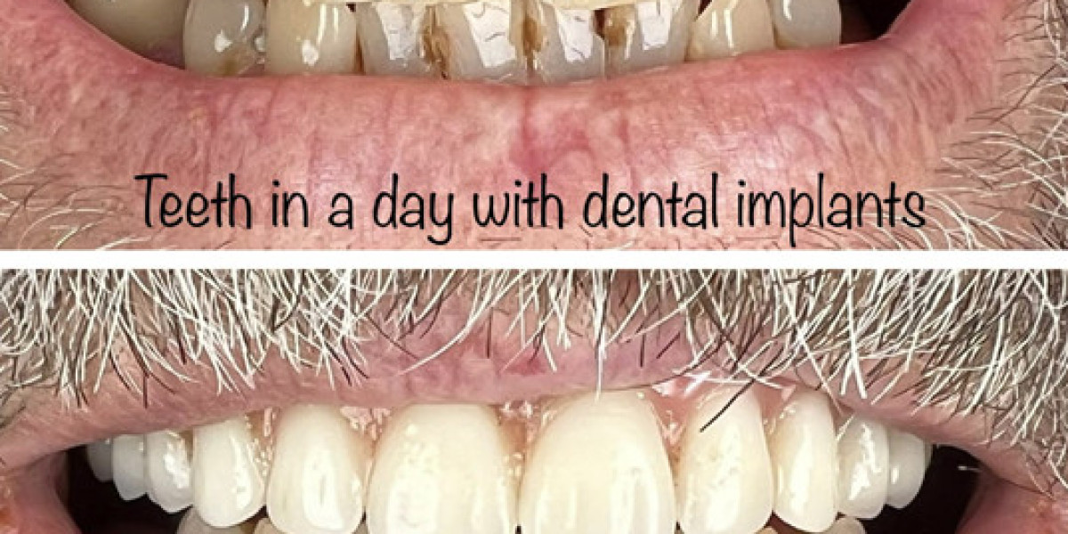 Full Arch Dental Implants Long Island: A Smile Transformation Worth Smiling About