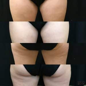 CoolSculpting vs. Sono Bello - Which One is Better? VIVAA