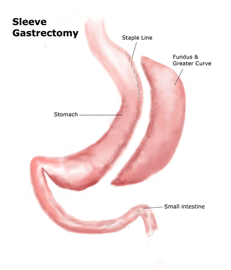 Sleeve Gastrectomy | Obesity Treatment Procedure [2023] | Nexus Surgical