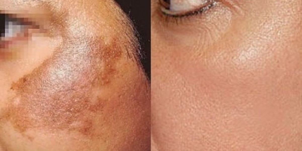 Exploring the Different Types of Dermal Pigmentation Treatments