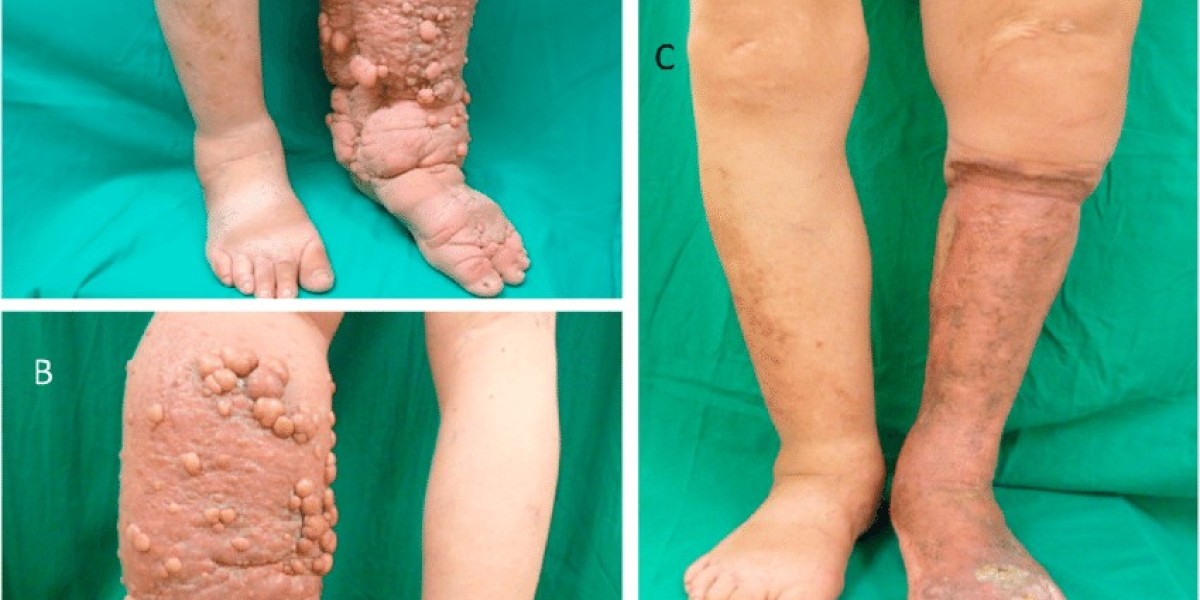 Ovarian Cancer And Lymphedema: Managing Swelling