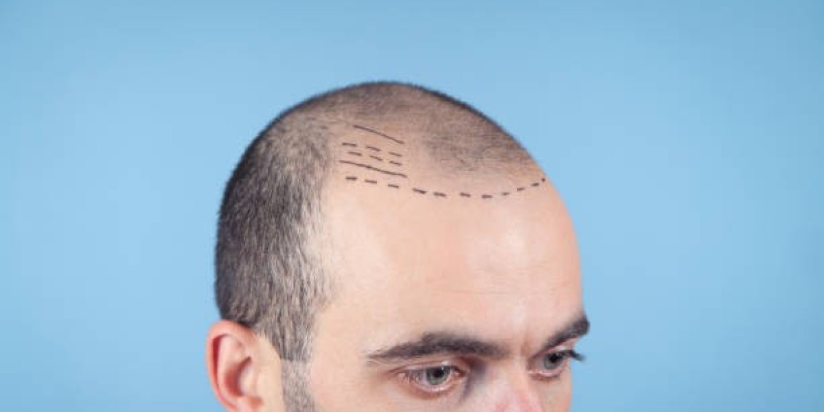 From Consultation to Recovery: A Step-by-Step Guide to Hair Transplants in Riyadh