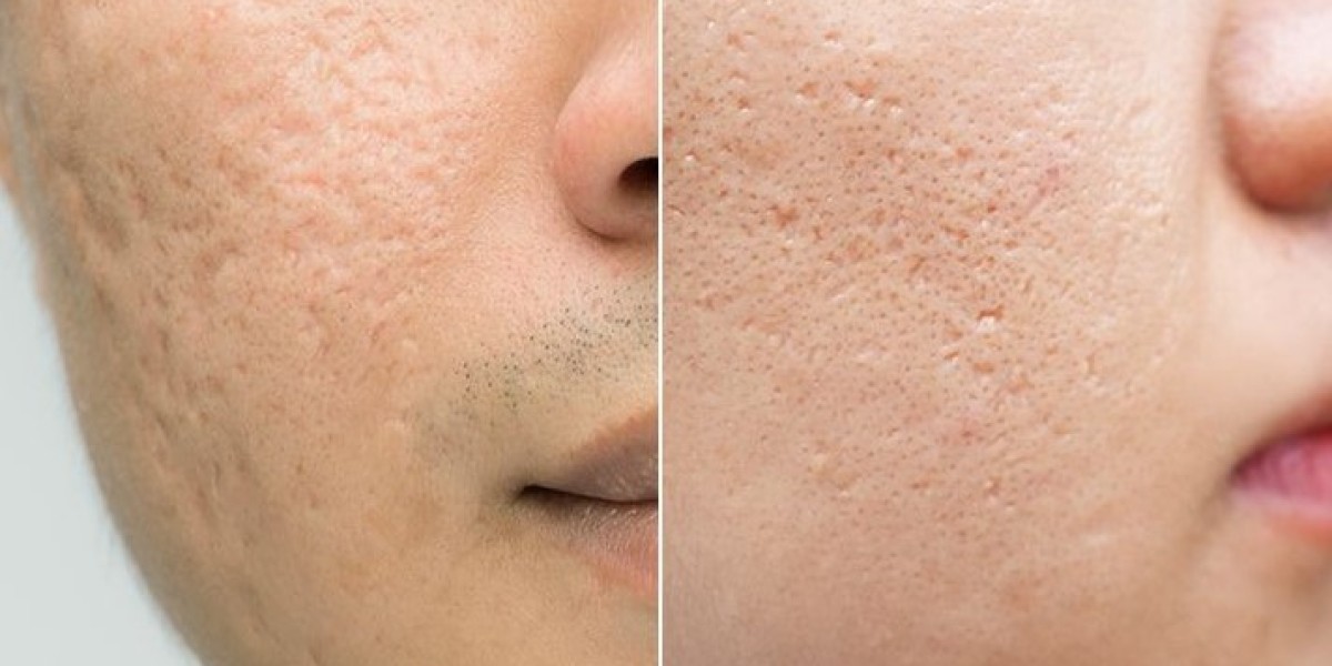 Exploring Acne Scar Treatment Options in Singapore: Your Path to Flawless Skin