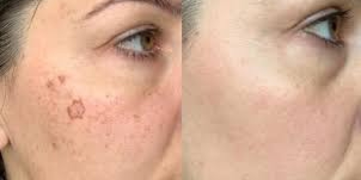 How to Choose the Right Pigmentation Treatment for You