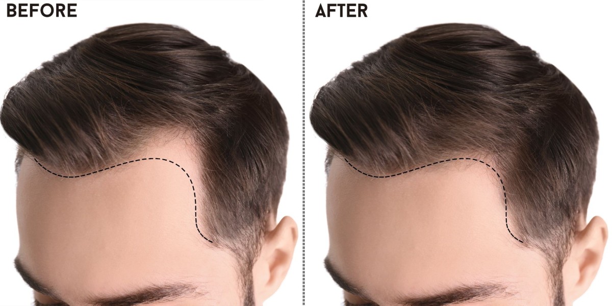  The Rise of Global Hair Transplant Systems: Trends and Innovations