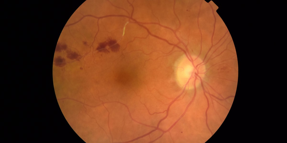 Advancing Treatment for Global NPHP5 Retinal Degeneration