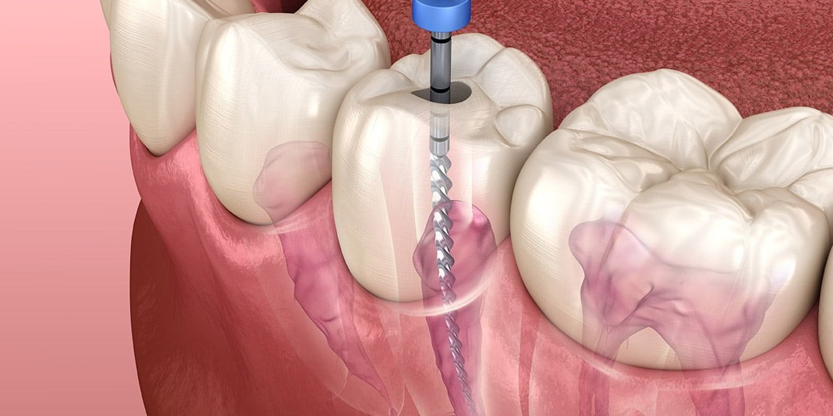 Navigating Root Canal Files: Techniques and Tools