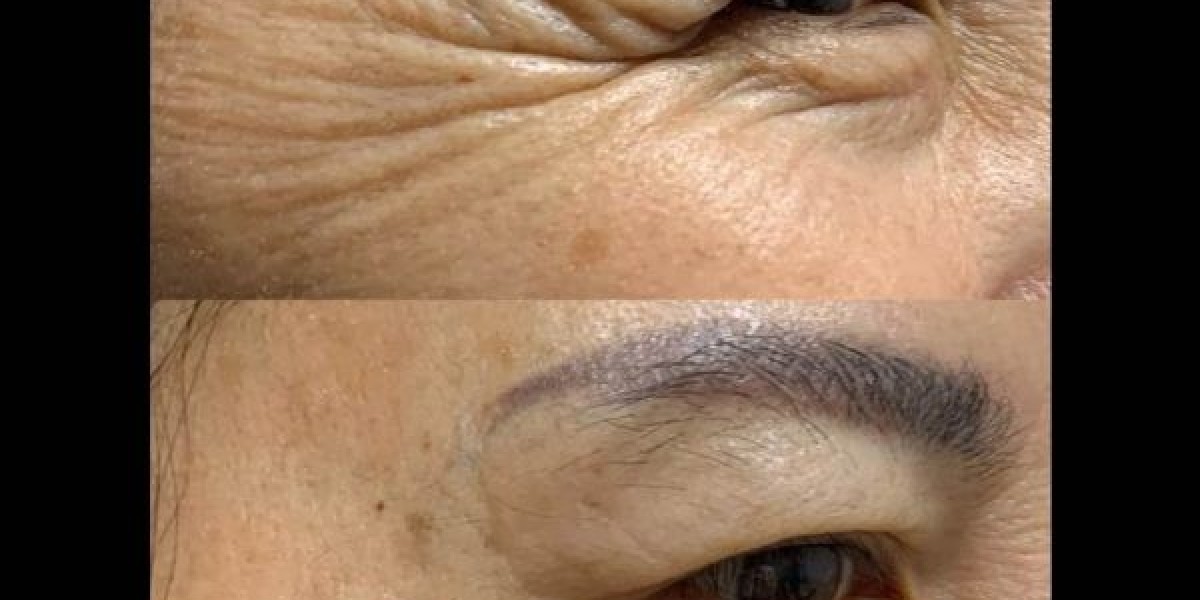 Get That Glowing Skin with an Anti-Wrinkle Injection Treatment