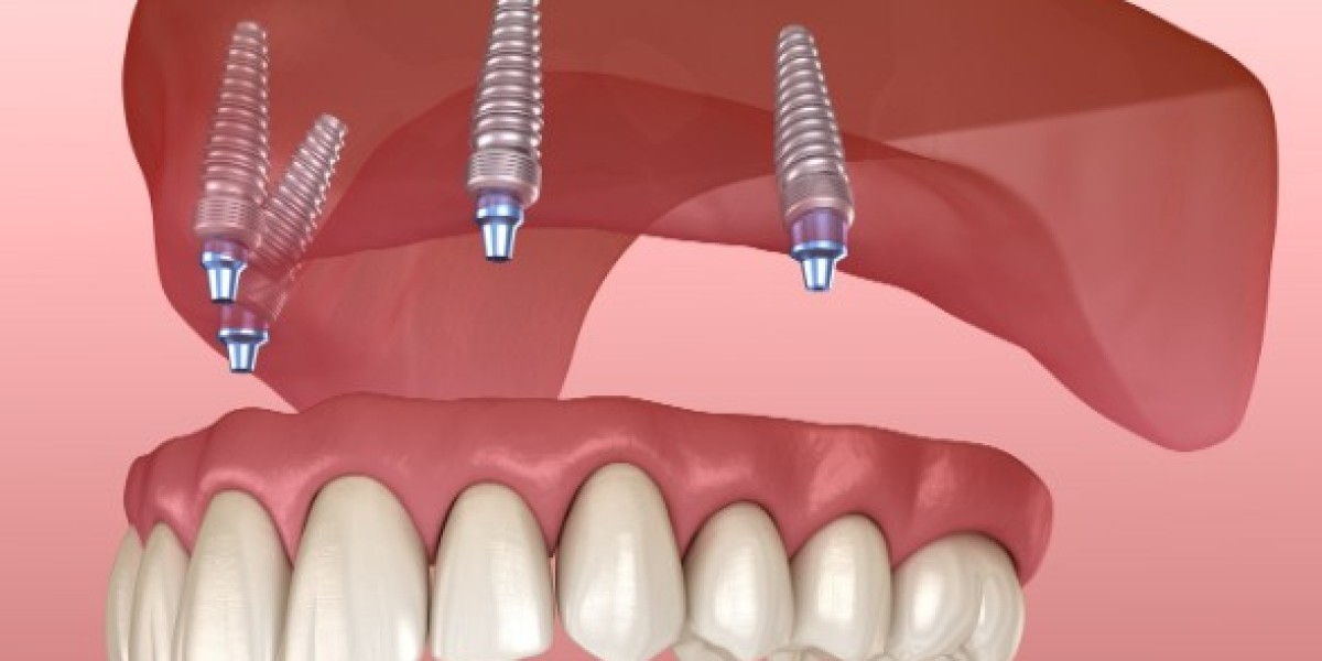 Full Mouth Dental Implants in FL: Restoring Smiles and Confidence with Advanced Dental Solutions