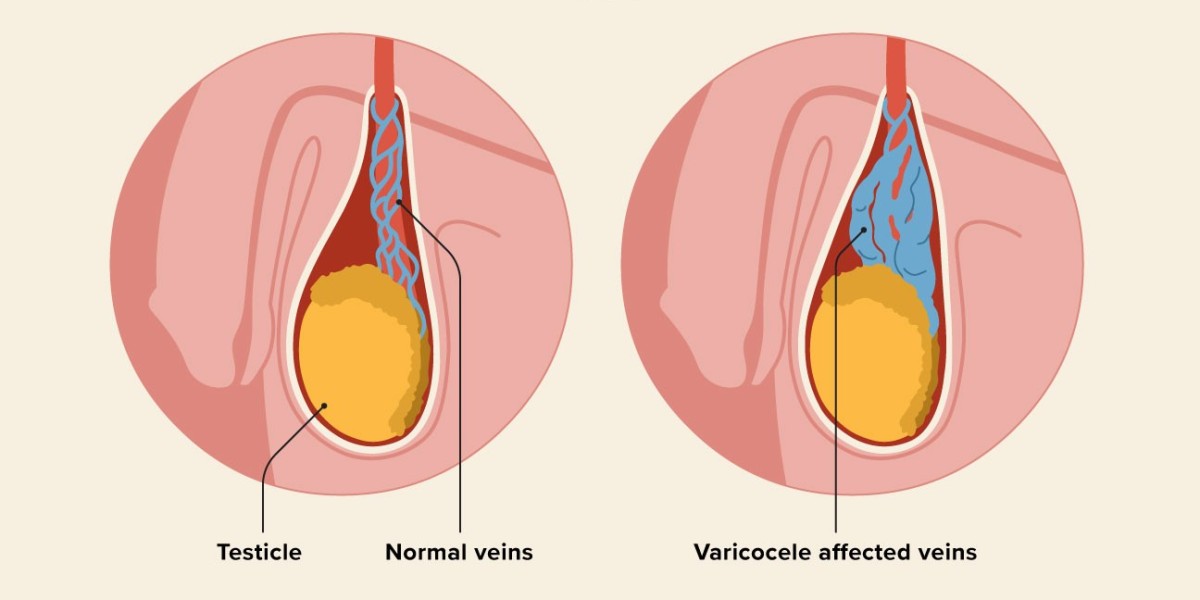 Unraveling the Mystery of Varicocele Causes: Understanding the Significance of Varicocele Embolization