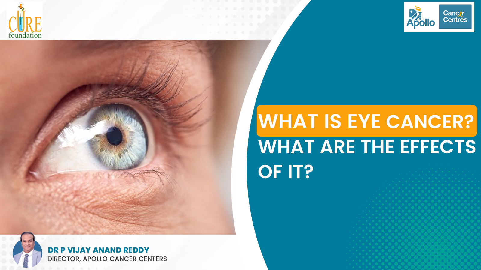 What is Eye Cancer? What are the effects of it? - Dr Vijay Anand Reddy