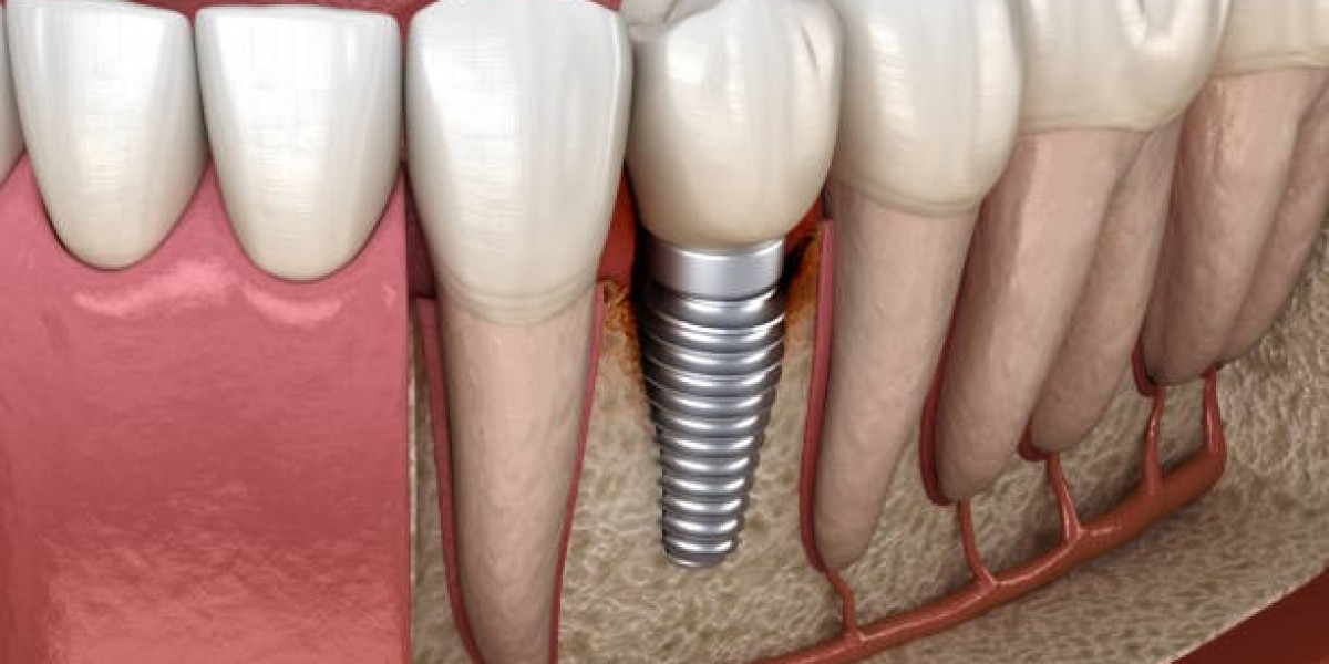 How to Prevent Implant Bone Loss