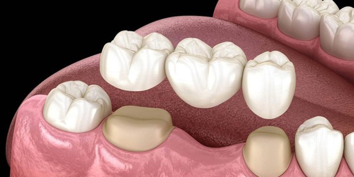 Embrace the Future of Full Smiles with San Dimas All-on-4 Implants in Bakersfield